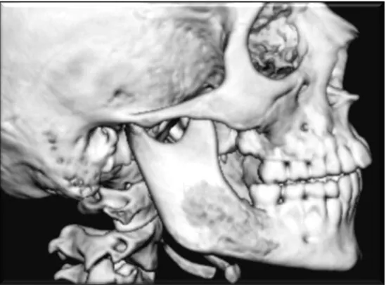 FIGURA 12:  Imagem 3D obtida por TC, na qual revela o sítio e as dimensões da lesão  do lado direito, a osteólise difusa e os distúrbios na arquitetura óssea