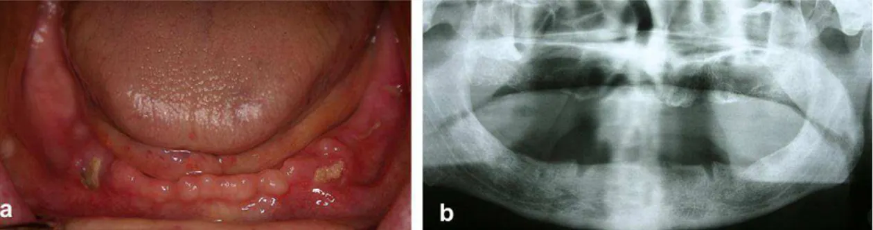 FIGURA  06  –  Osteonecrose  em  mandíbula  associada  ao  uso  de  bisfosfonatos.  Extensa área de osso necrótico exposto