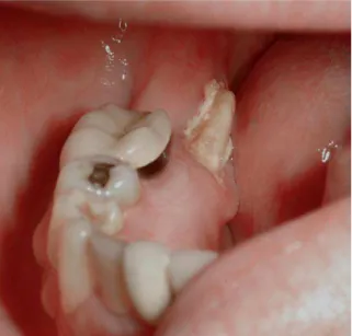 FIGURA 15  – Área de osso necrótico exposto em região anterior de mandíbula sem  sinais de cicatrização pós-exodontias