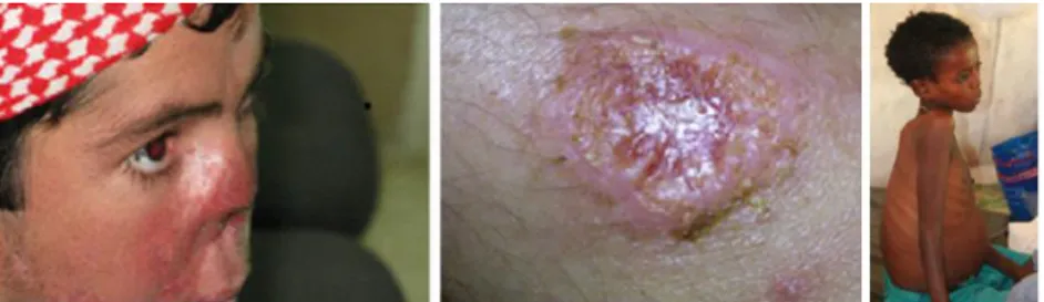 Figure 2.5: Illustration of the different clinical symptoms of leishmaniasis: mucocutaneous, cutaneous, and visceral, respectively  (adapted from [7])