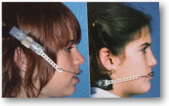 Fig. 1 – High-pull and cervical headgears. [1]!