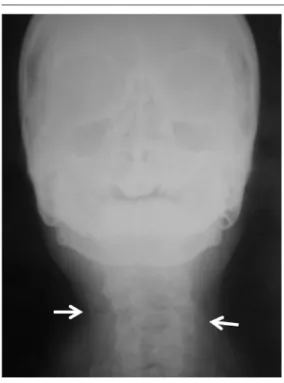 Table 2 shows the distribution of uni and bi- bi-lateral cases of calciications detected on PR and  the factors studied; there was no correlation  be-tween the factors and laterality