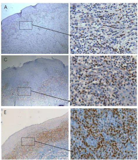 Figura 4: Fotomicrografias mostrando reação positiva para o anticorpo anti-Bcl2. A e B) 