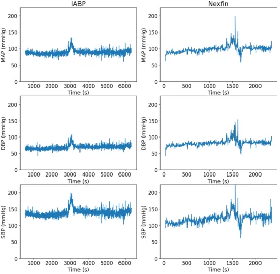 Figure 5.1: Representation of the raw signals obtained with the PAC and the Nexfin device of the ClearSight System for the MAP, DBP and SBP - example of the patient 5