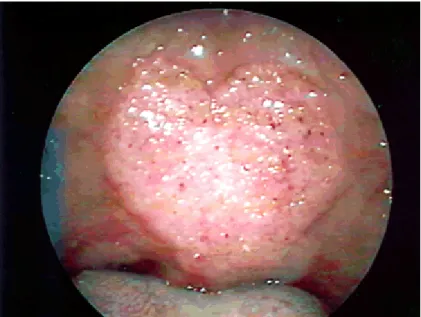 FIGURA 7 - Estomatite moriforme, com pontilhado hemorrágico fino em palato (PALHETA-NETO 2003)