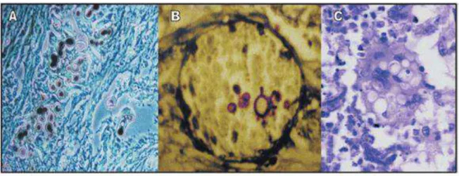 FIGURA  16  –  Cortes  histológicos  demonstrando    Paracoccidioides  sp.  em    Coloração  de  Grocott