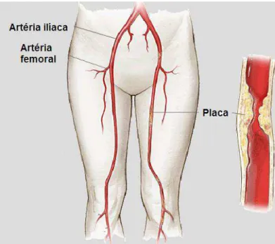 FIGURA 1: Desenho ilustrativo da oclusão de um segmento arterial de membro  inferior. A DAP se inicia com a obstrução do fluxo sanguíneo arterial nos membros  inferiores