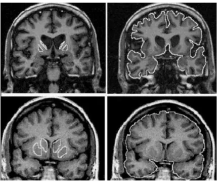 Figura 1:Imagem de Ressonância Magnética (modificada) do cérebro de indivíduos com DH  (acima) e indivíduos que não apresentam a doença (abaixo)