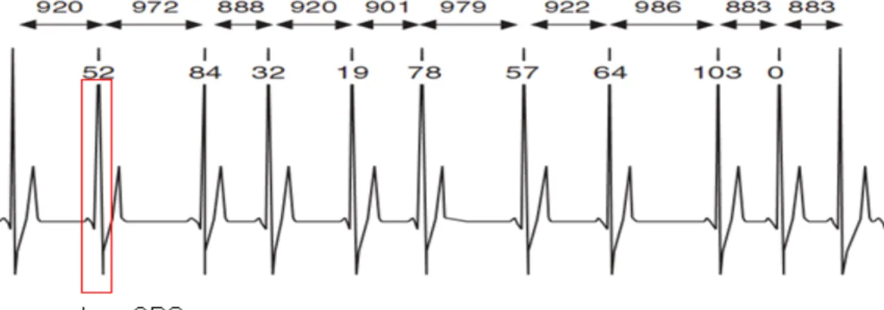 Figura 6: exemplo de ECG com 11 batimentos 