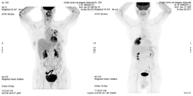 FIGURA 2 -  Imagens tomográficas ilustrativas da  18 F-FDG PET/CT de diferentes pacientes