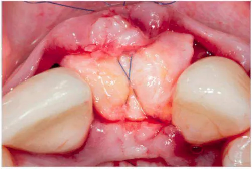 Figura 6  – Exemplo clínico: Encerramento cirúrgico após posicionamento do enxerto de tecido  conjuntivo subepitelial colhido do palato, para aumento do rebordo com tecidos moles, através da  técnica do colchoeiro horizontal