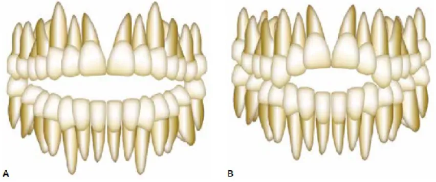 Figura 9 A - Mordida aberta anterior esquelética; B- Mordida aberta anterior dentária – adaptado de Valarelli &amp; Janson ( 2014) 