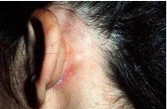 FIGURA 3 – Dermatite seborreica. Eritema e descamação em região  retroauriocular e margens do couro cabeludo