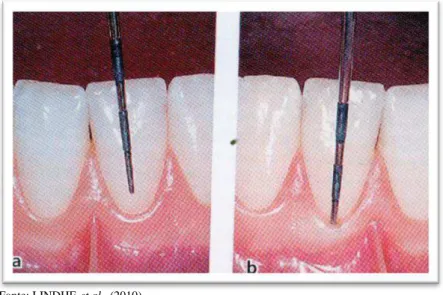 Fig.  4  Uma  sonda  periodontal  foi  introduzida  na  interface  dente/gengiva  e  abriu- se  “artificialmente  um  sulco 