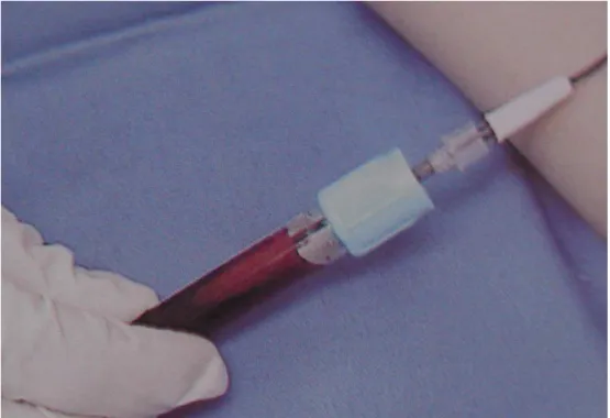 FIGURA 7 - Presença do fluxo sanguíneo e coleta do sangue com o vacutainer 