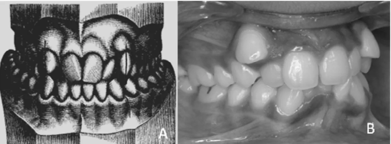 Figura 2. Maloclusão de Classe I. A. Esquema em vista frontal mostrando o posicionamento incorreto  dos  dentes