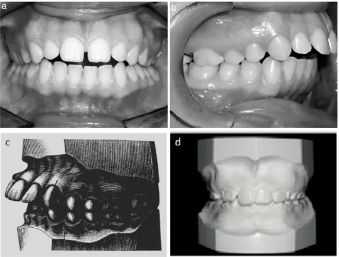 Figura  3.  Maloclusão  de  Classe  II.  Fotos  de  pacientes  de  Classe  II  divisão  1  mostrando  mordida  profunda e incisivos proeminentes em vista frontal (A) e vista lateral (B)