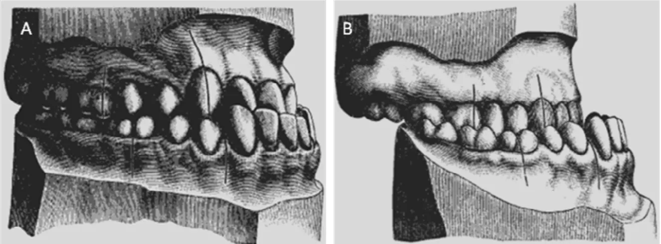 Figura  4.  Maloclusão  de  Classe  III.  Esquema  mostrando  a  vista  lateral  sendo  possível  observar  a  oclusão  mesial  ao  normal  dos  molares  inferiores,  onde  em  A