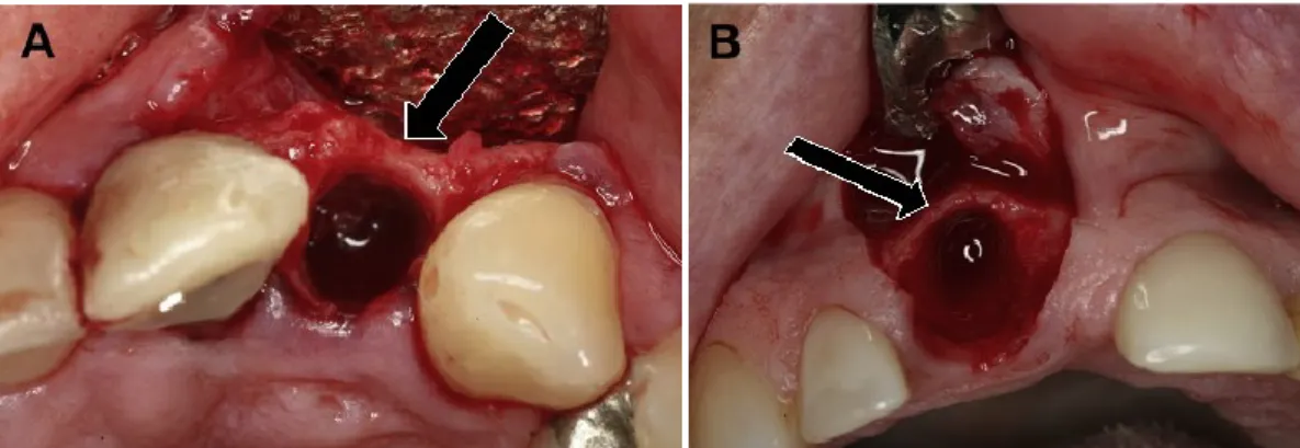 Figura 1 - (A) Osso vestibular espesso (seta) após extração; (B) Osso vestibular fino (seta) após extração