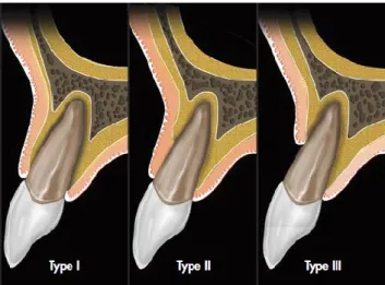 Figura 2 - Ilustração dos três tipos de alvéolos de extração, definidos pelo tecido mole e parede óssea  vestibular presentes (tipo I, II e III) (Adaptado de Elian et al, 2007)