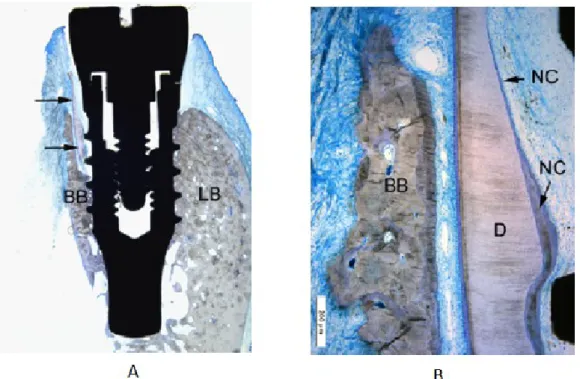 Figura 3: A, Secção vestíbulo-lingual de uma amostra, onde se observa um gap até 0.5mm entre o fragmento  da raiz e o implante (setas), BB-tábua óssea vestibular, LB-tábua óssea lingual, observam-se os tecidos  moles perimplantares saudáveis