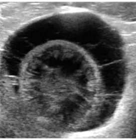 Figura 8- Mucocélio da vesícula biliar (Fonte: Larson, 2016). 