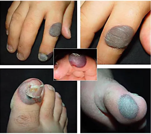 Fig. 1. Tense hemorrhagic blisters on the patient’s fingers and toes. 