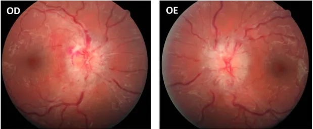 Figura  1  –  Retinografia  ODE  centrada  no  disco  ótico.  Papiledema  em  doente  com  hipertensão intracraniana idiopática