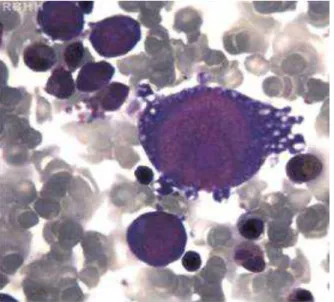 Figura  4  –  Pronormoblasto  gigante  com  inclusões  citoplasmáticas  sugerindo infecção pelo B19V