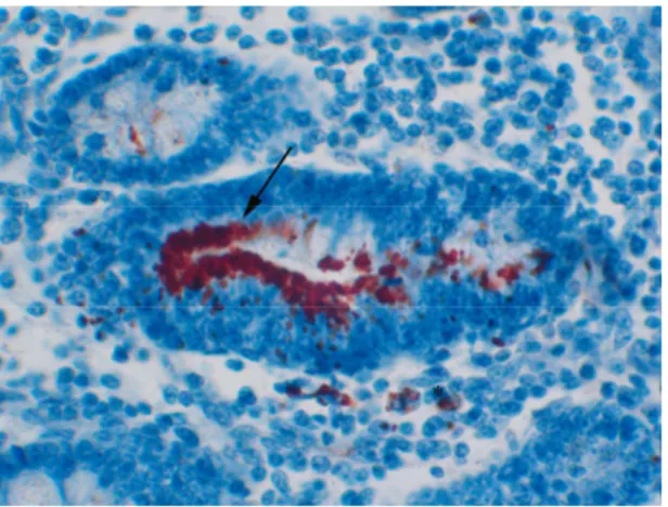 Figura  4  –  Suíno,  intestino  delgado.  Detecção  imuno-histoquímica  de  Lawsonia  intracellularis,  observa-se  marcação  no  ápice  dos  enterócitos  da  cripta  intestinal  (seta)  e  em  macrófagos  na  lâmina  própria  (asterisco) (IHQ 40X)