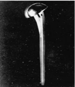 Figura  2  –  Primeira  prótese  umeral  de  Neer para o tratamento de fraturas  (De Neer et al.: Fracture of the neck of the  humerus  with  dislocation  of  the  head  fragment