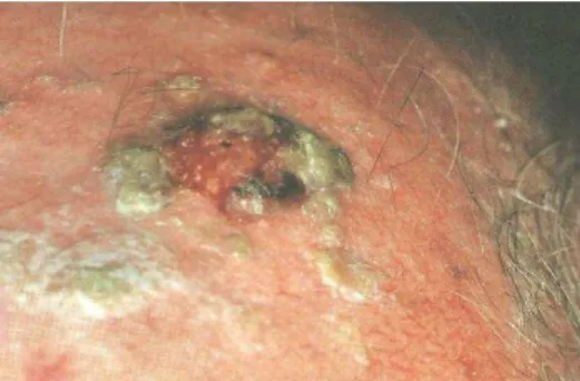 Figura 8- Carcinoma espinocelular (CEC) (Bahia, 2003). 