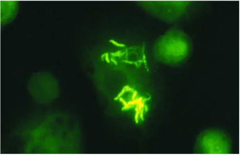 Figura 8-Mycobacterium Tuberculosis visualizado através de coloração de Ziehl-Neelsen (Huggett  et al., 2003)