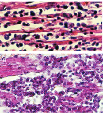 Fig. 12: common denominator of heart pathology in human and kDNA mutated chicken. A: confluent, minimal rejection units  pro-voking diffuse myocarditis in a chronic Chagas patient