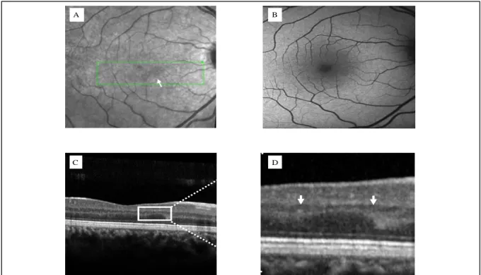 Figure 3: One-month follow-up multimodal imaging of the right eye. A- Near-infrared reflectance showed a barely  defined lesion (arrowhead)