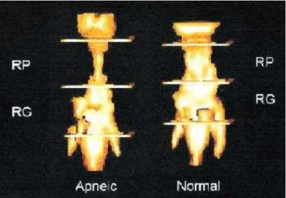 Figura 10: Volume das VAS representado tridimensionalmente num paciente portador da SAHOS   (esquerda) e num indivíduo normal (direita) 