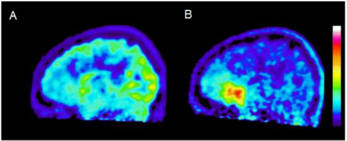 Figure 1.2 -  High-grade glioma in the frontal lobe. (A) FDG PET. (B) FET PET. Delineation of the tumour is difficult  on FDG images, while FET depicts the solid tumour mass and indicates an optimal biopsy site [13]
