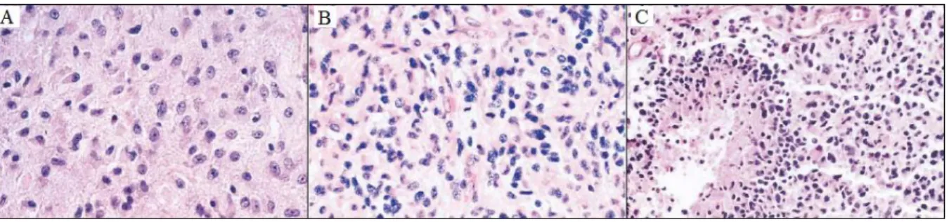 Figure  1.6  -  Histologic  criteria  of  the  WHO  for  the  classification  of  gliomas
