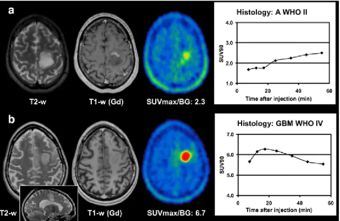Figure  1.7  -  Examples  of  a)  low-grade  tumour  and  b)  high-grade  tumour.  Both  studies  show  circumscribed  hypertense lesions in T2-weighted MRI with pathologic contrast enhancement