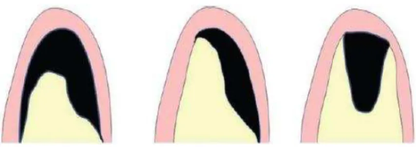 Fig. 2- Tipos de defeitos ósseos. Da esquerda para a direita: tipo vertical e horizontal; 