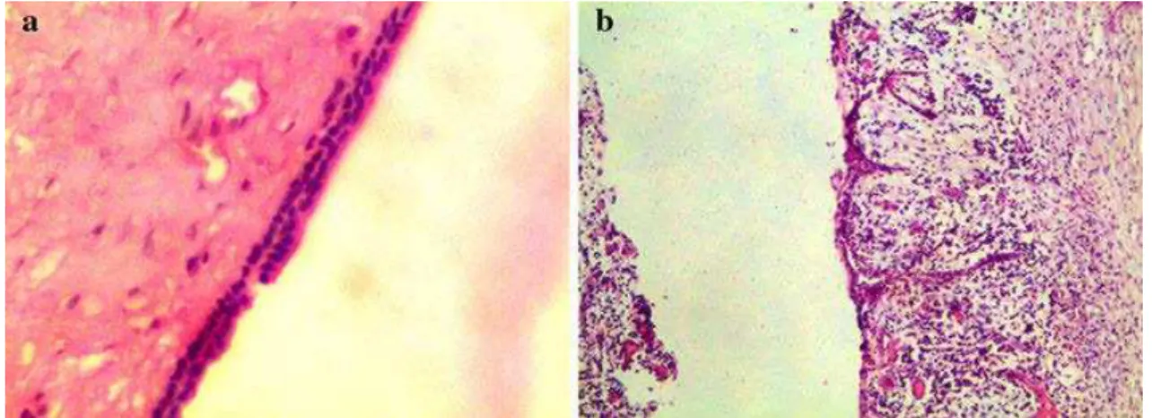 Fig. 2 – a-Parede quística com revestimento epitelial fino e não queratinizado; b-Parede  quística com áreas de inflamação e um aumento da espessura do revestimento epitelial  (Suresh et al., 2011)
