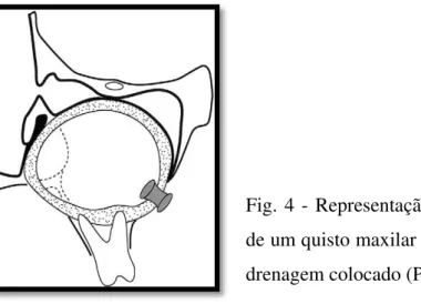 Fig. 4 - Representação esquemática da descompressão  de um quisto maxilar na cavidade oral com um tubo de  drenagem colocado (Pogrel, 2005)