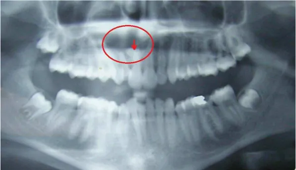 Fig. 6 – Ortopantomografia que mostra o quisto dentígero com o mesiodens impactado  (Dwivedi et al., 2012)