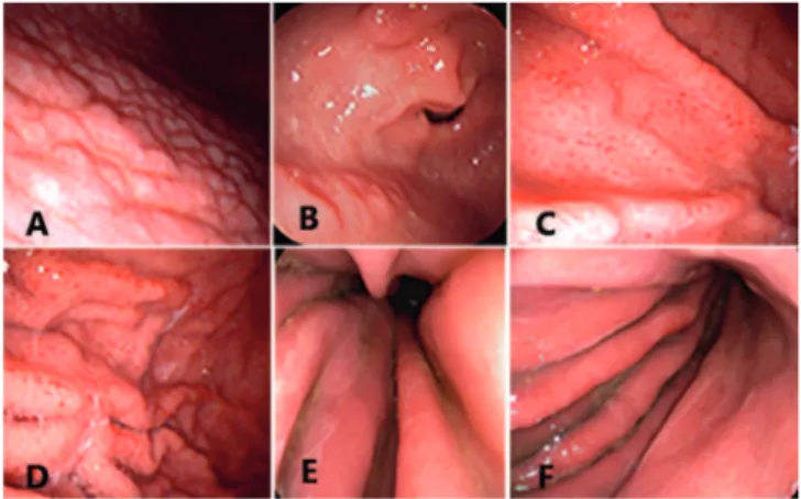 FIGURA 1 - Achados endoscópicos relacionados ao HP positivo:  A) antro gástrico com nodularidades; B) antro  com erosões elevadas;  C e D) corpo gástrico com  enantema salpicado ou em mosaico; E e F) enantema  difuso com edema de pregas e exsudato.