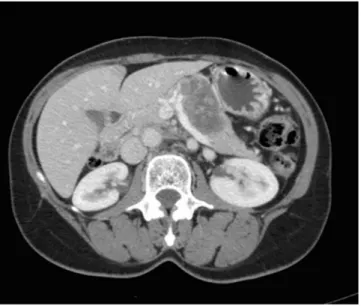 FIGURA 4 – Tumor no corpo e cauda do pâncreas (paciente 7)