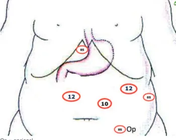 FIGURA 2 – A) Início da dissecção na grande curvatura a 