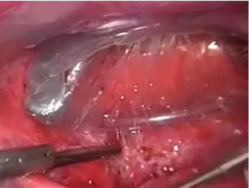 FIGURA 3 – Anel do dispositivo na cavidade abdominal ao  redor da incisão