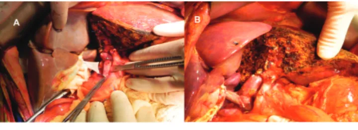 FIGURA 1  - A) Espaço na cavidade após a hepatectomia direita  para implantar todo o enxerto de fígado