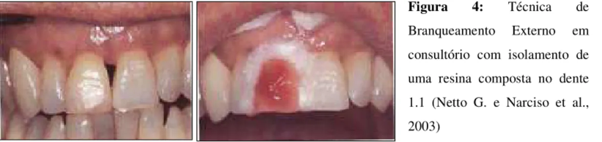 Figura  4:  Técnica  de  Branqueamento  Externo  em  consultório  com  isolamento  de  uma  resina  composta  no  dente  1.1  (Netto  G