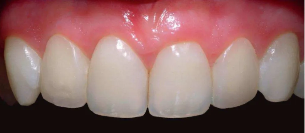 Figura  7:  Aspeto  final  dos  dentes  anteriores  com  o  restabelecimento  da  anatomia  dos  incisivos laterais, após a restauração direta com resinas compostas